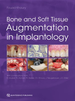 cover image of Bone and Soft Tissue Augmentation in Implantology